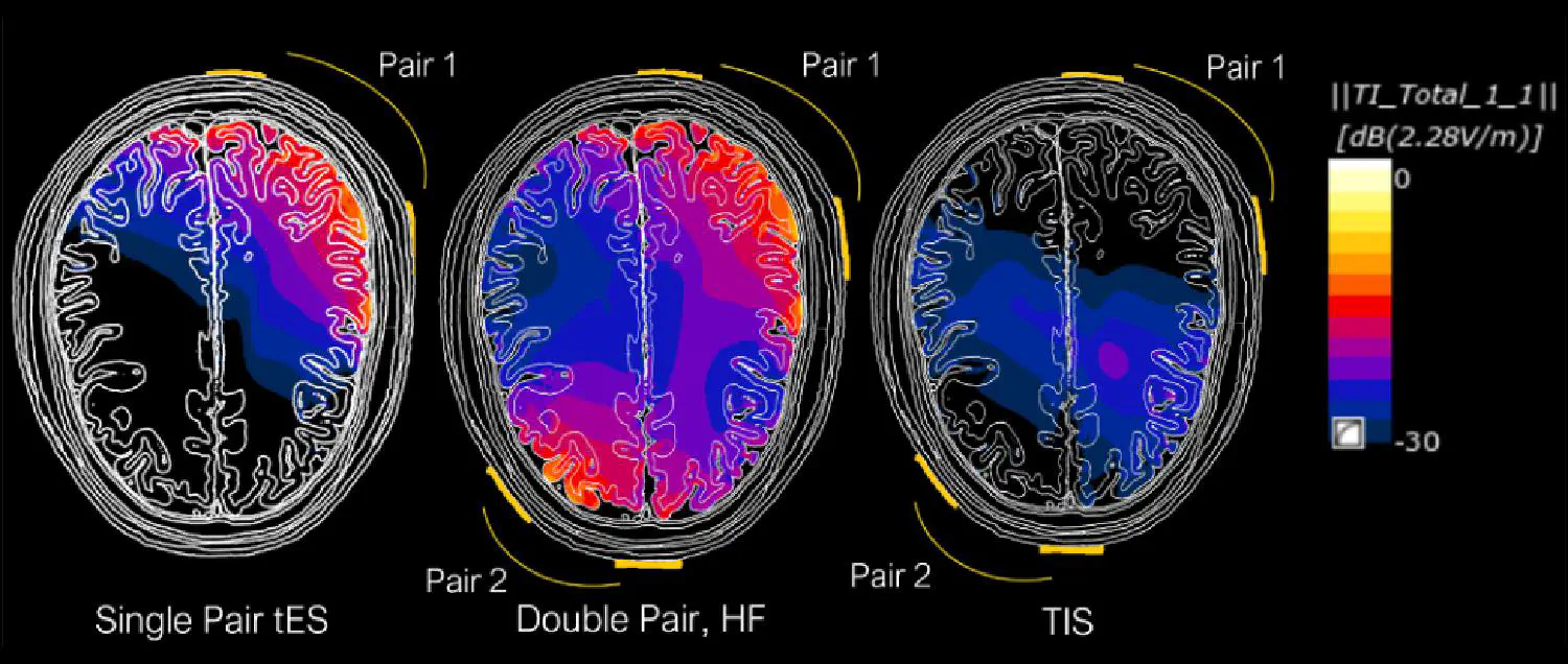 Fig1-comparing-TI-stimulation-and-tES.jpg